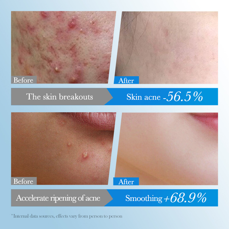 All-english SADOER acne patches, colorful acne patches, student acne patches, cross-border export wholesale Specification drawing