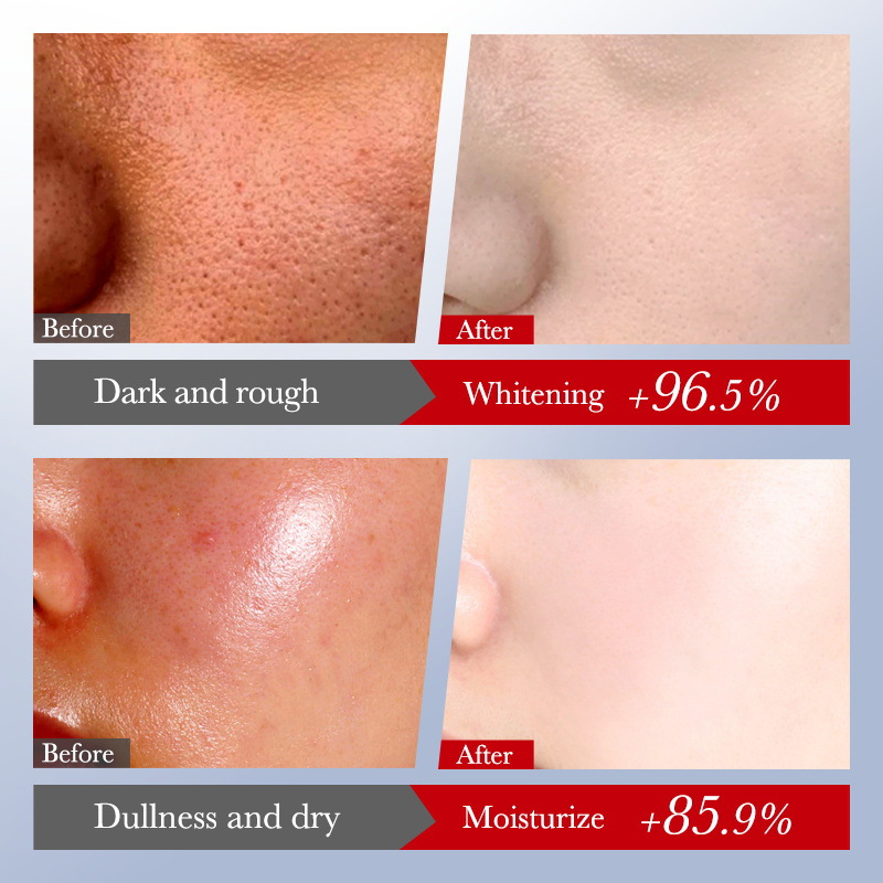 Cross-border export wholesale of SADOER Kojic acid Whitening and freckle-Removing six-piece set, brightening, Moisturizing and hydrating set Application Scenario