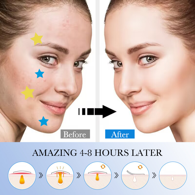 All-english SADOER acne patches, colorful acne patches, student acne patches, cross-border export wholesale Item Picture