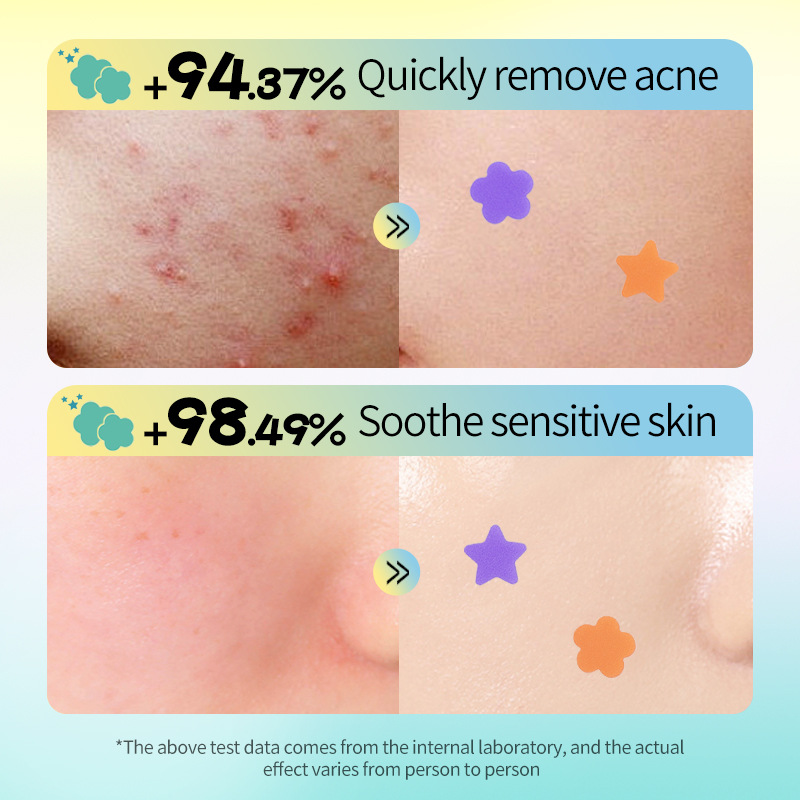 SADOER star flower-shaped acne patches 40 patches, student acne removal patches, cross-border export wholesale Application Scenario