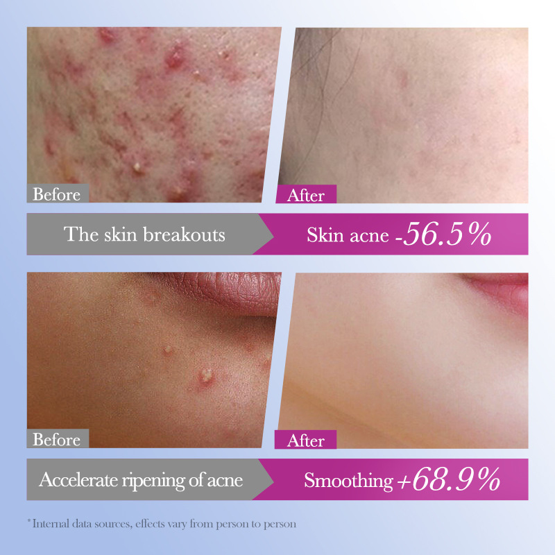 All-english SADOER acne patches, colorful acne patches, students go to acne cross-border foreign trade wholesale Specification drawing