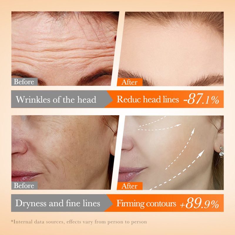 Cross-border wholesale of SADOER Multi-peptide VC freeze-dried Cheek and Forehead Filling Essence Set in full English Application Scenario