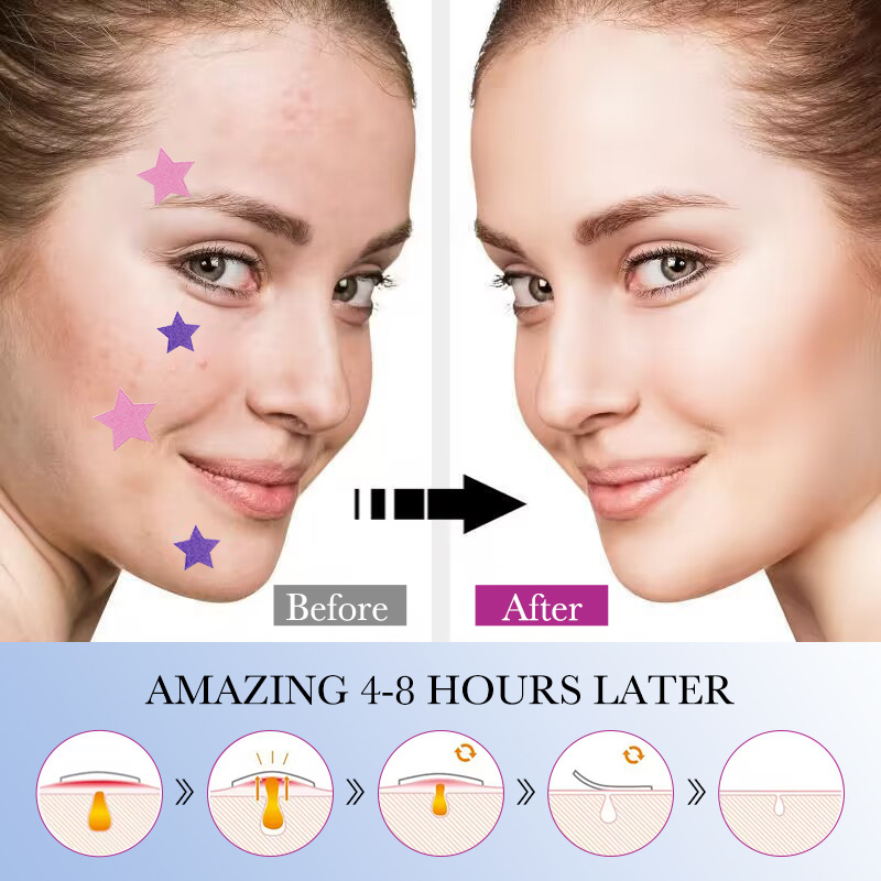 All-english SADOER acne patches, colorful acne patches, students go to acne cross-border foreign trade wholesale Item Picture