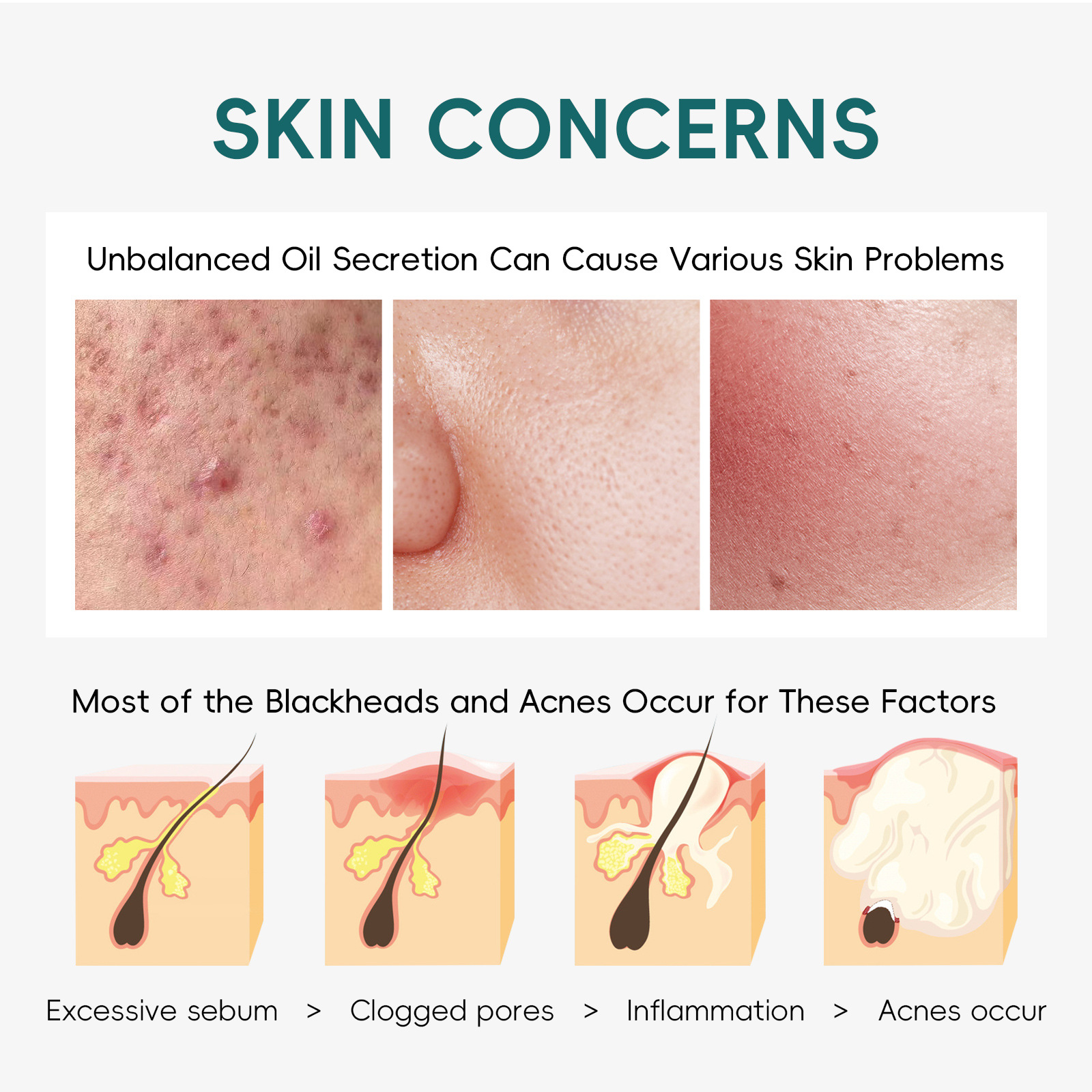 Cross-border new product LAIKOU Australian Tea Tree Acne Removal Wet Compress Cotton Tablets 100ml/3.38floz.40 tablets for export details Picture
