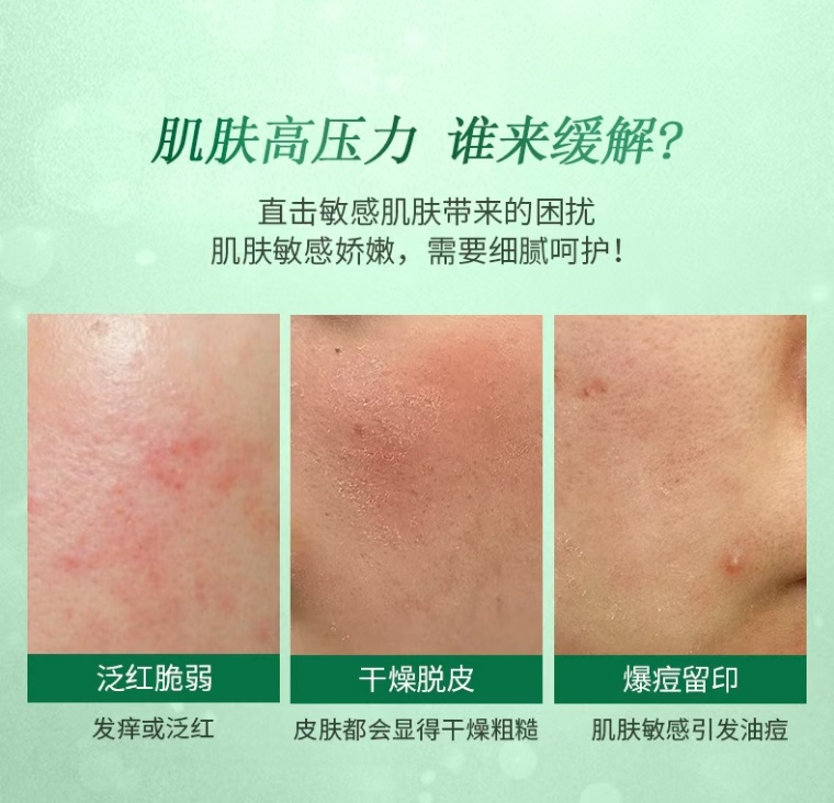 Cleansing and Soothing Hydrating Essence, specializing in acne removal and fading marks, with extracts of Sarcandra glabra and peony, regulates the flora and is suitable for all types of acne-prone skin. pic 4