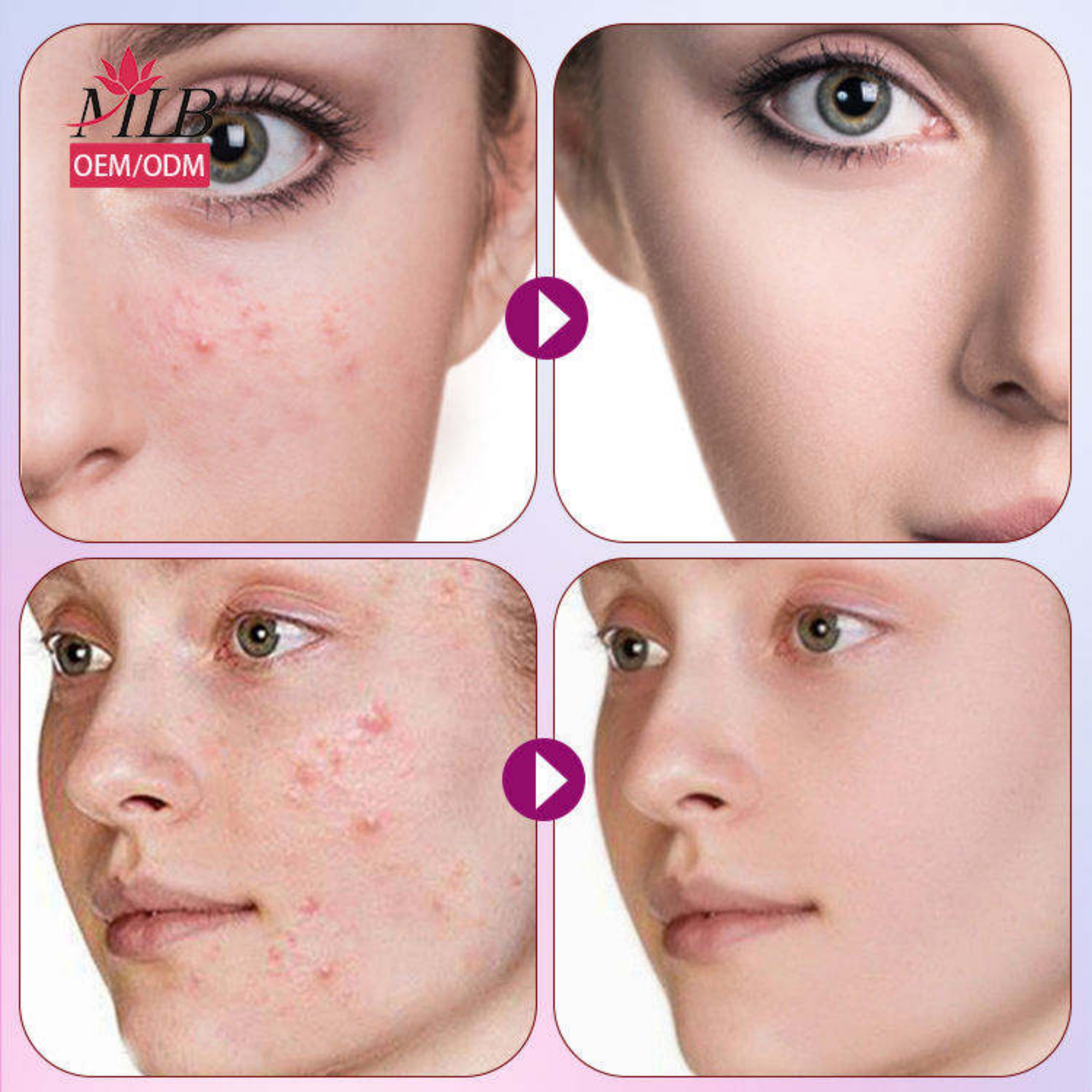 Customized labels, variable-shaped acne patches, dot-shaped acne care acne patches details Picture