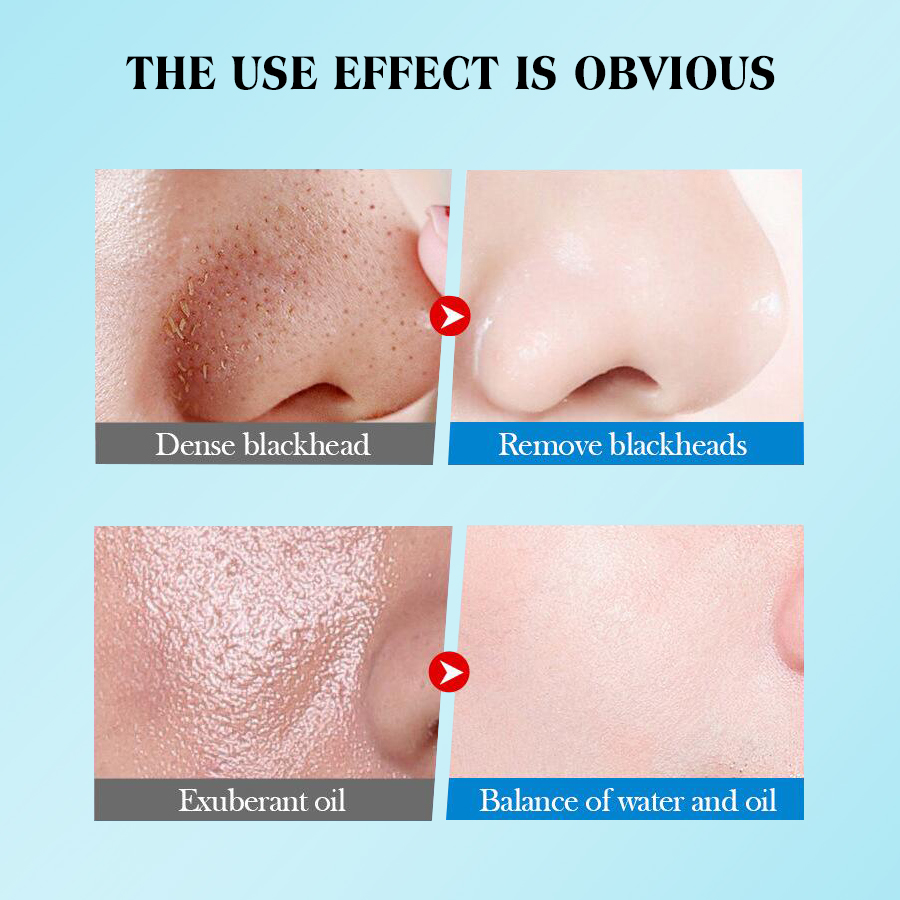 DEAR SHET District Snail Blackhead Nose Mask Box Set Cross-border Foreign Trade Live Streaming Wholesale Application Scenario