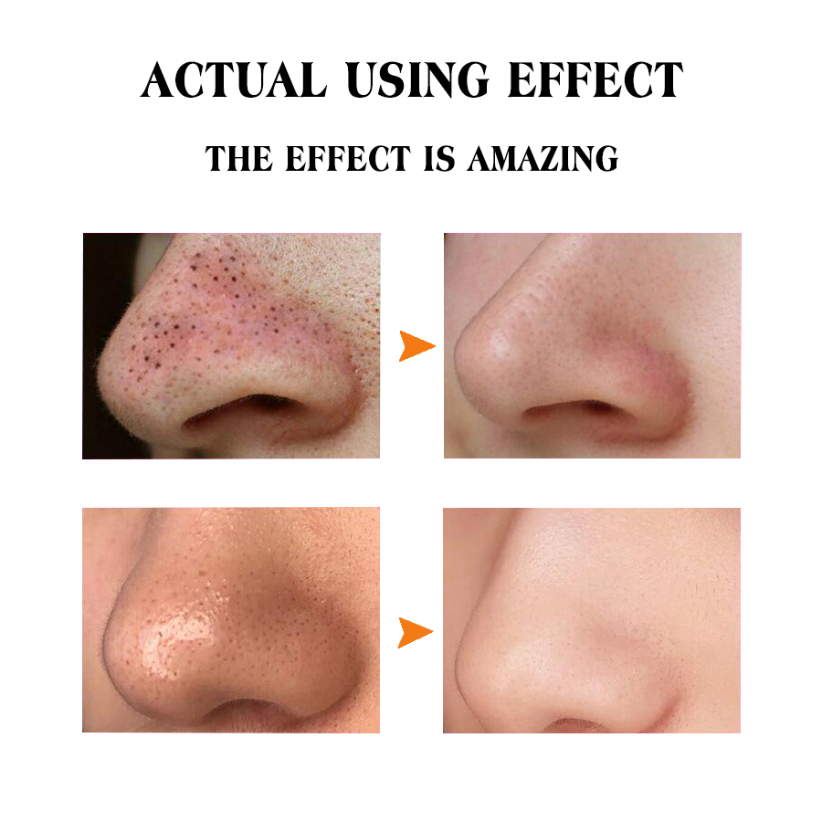 Cross-border factory customized bulk vitamin C blackhead removal nasal patches deeply clean pores and bid farewell to strawberry noses Application Scenario