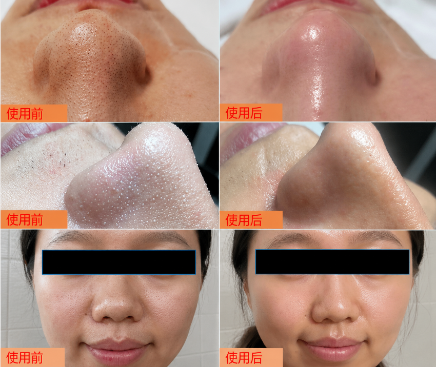 DR.URUR Blackhead Cleansing Essence 100ml Blackhead Removal Cleansing Water Salicylic Acid Pore Refining Essence Oil Control Cleansing Application Scenario
