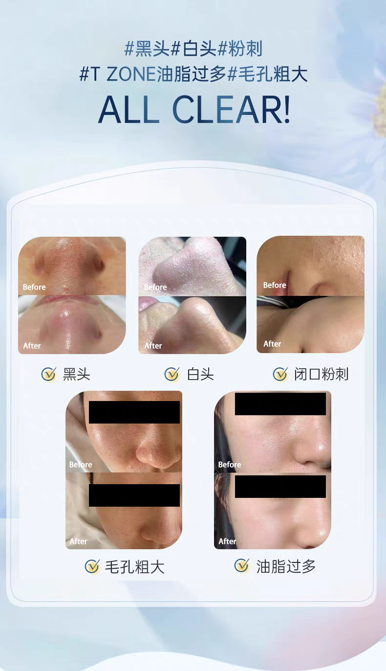 DR.URUR Blackhead Cleansing Essence 100ml Blackhead Removal Cleansing Water Salicylic Acid Pore Refining Essence Oil Control Cleansing detail image 10